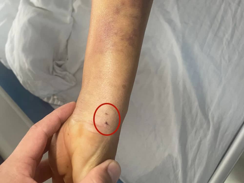 被蛇咬傷怎么辦？ 福德醫(yī)院教你毒蛇咬傷急救指南
